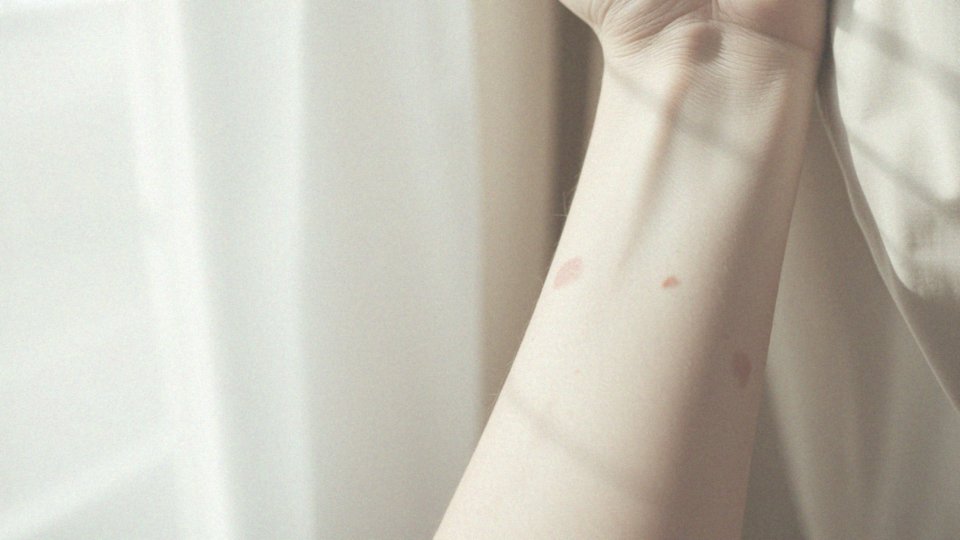 Jakie objawy towarzyszą wysypce alergicznej?